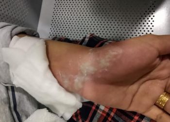 iPhone Explosion left A woman with serious burns