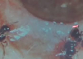 Doctors Find Four Live Bees Inside Woman's Eye