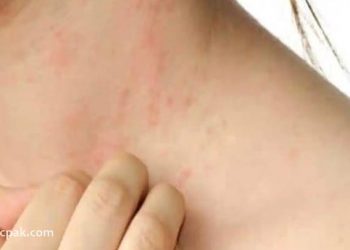 Skin rash a new emerging symptom of coronavirus