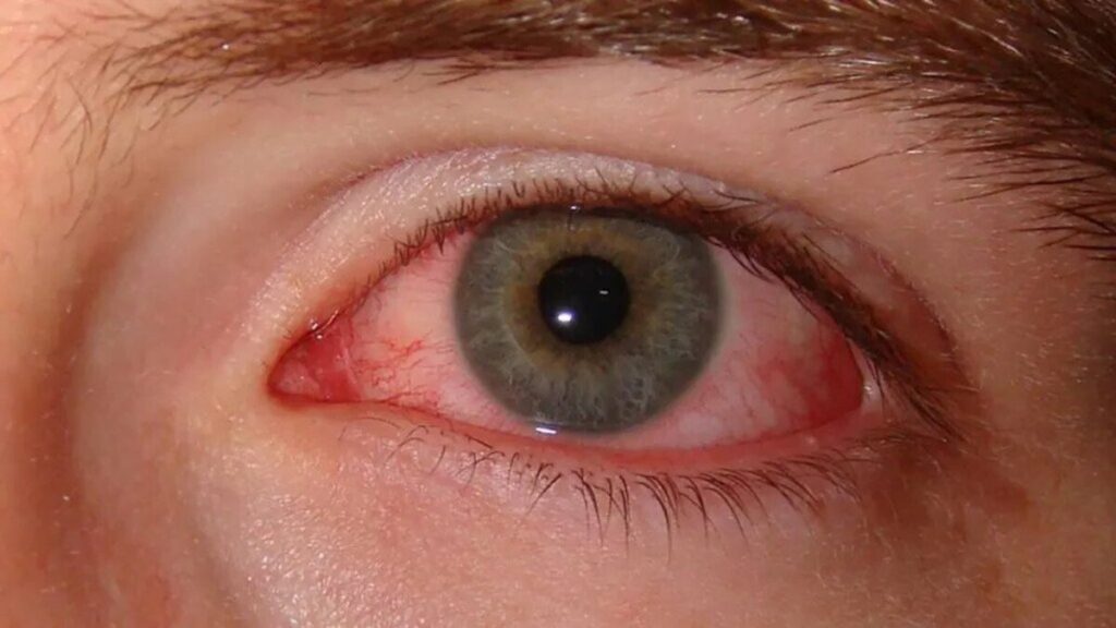 Pink Eye Infection Karachi, Conjunctivitis Karachi