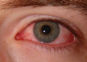 Pink Eye Infection Karachi, Conjunctivitis Karachi